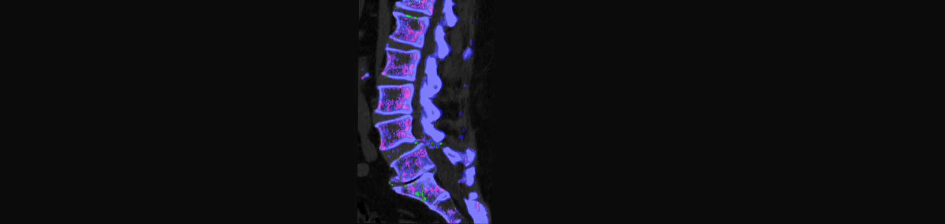 Yorkville Chiropractic and Wellness Centre is aware that inflammatory spinal gout is a differential diagnosis to consider for patients who present with back pain and other spine related symptoms.