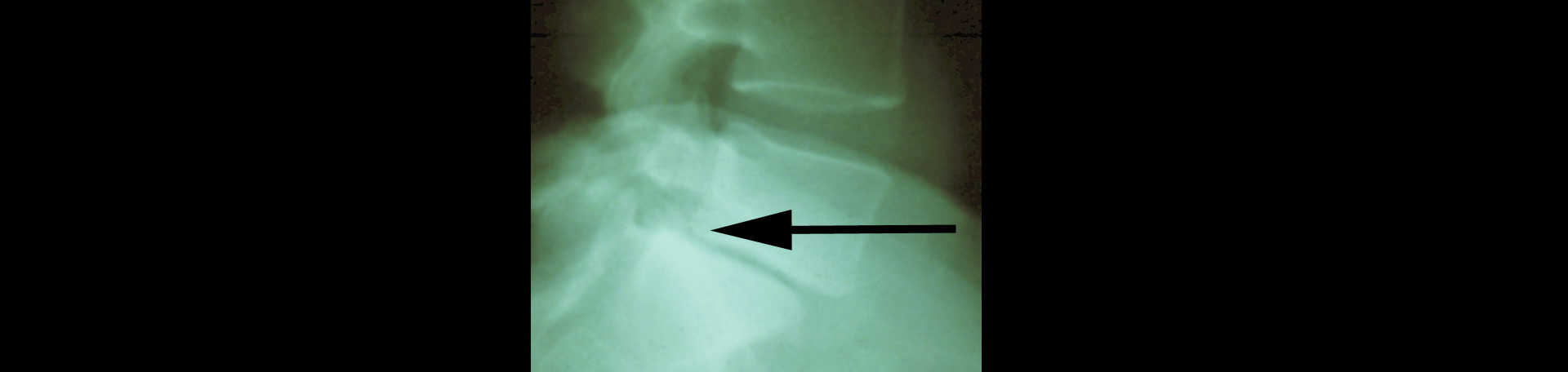 Toronto spondylolisthesis