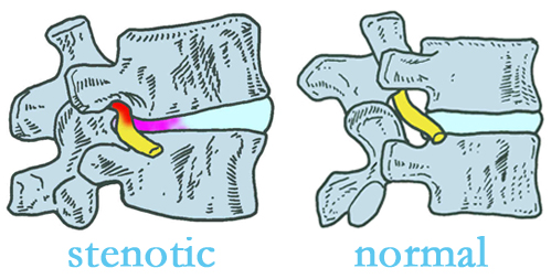 Toronto stenotic and normal spinal discs