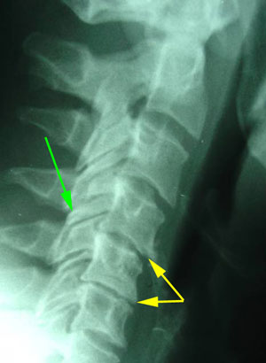 disc degeneration treated at Yorkville Chiropractic and Wellness Centre