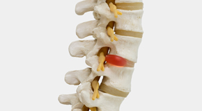 Toronto chiropractic conservative care helps even huge disc herniations go away