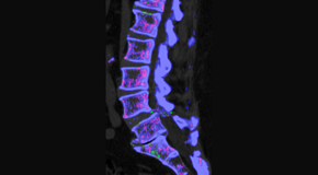 Yorkville Chiropractic and Wellness Centre is aware that inflammatory spinal gout is a differential diagnosis to consider for patients who present with back pain and other spine related symptoms.