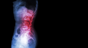 Toronto Chiropractic Care of Spondylolisthesis 