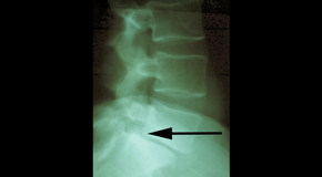 Toronto spondylolisthesis 