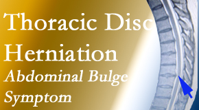 Yorkville Chiropractic and Wellness Centre treats thoracic disc herniation that for some patients prompts abdominal pain.