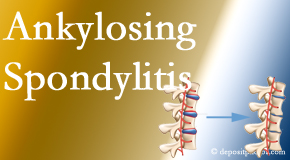 Yorkville Chiropractic and Wellness Centre offers gentle chiropractic spinal manipulation in the form of Cox Technic for ankylosing spondylitis management.