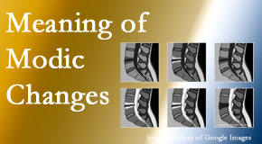 Yorkville Chiropractic and Wellness Centre sees many back pain and neck pain patients who bring their MRIs with them to the office. Modic changes are often seen. 