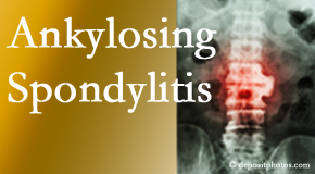 Ankylosing spondylitis is gently cared for by your Toronto chiropractor.