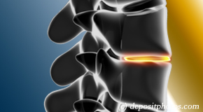 Toronto degenerative spinal changes 