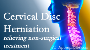 Yorkville Chiropractic and Wellness Centre uses the Cox® Technic spinal manipulation to treat cervical radiculopathy and avert surgery. 