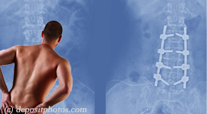 Toronto chiropractic relief for back pain after back surgery
