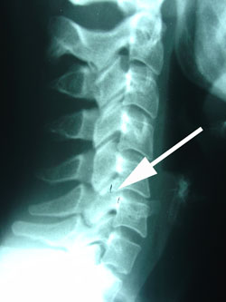 cervical spine subluxation