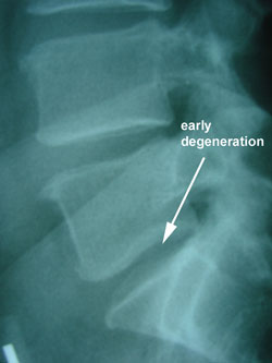 disc degeneration 