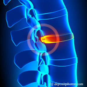 picture of lumbar Toronto disc herniation