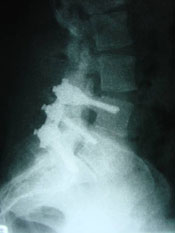 post surgical bolt fusion viewed from the side